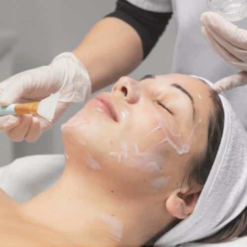 chemical-skin-peel